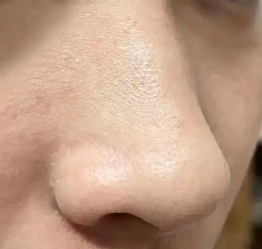 男生如何养成一张干净的脸毛孔粗大痘痘反复黑头问题的解决方法男士