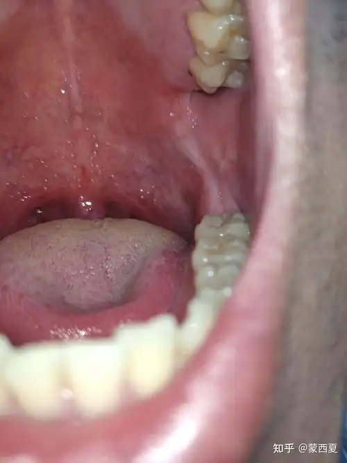 悬雍垂乳头状瘤 自切除 - 知乎