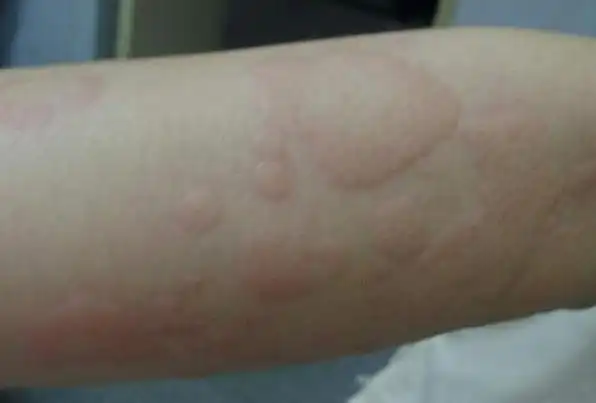 效果好!儿童过敏性荨麻疹"置莲怀袖中"-第1张图片-咖色网