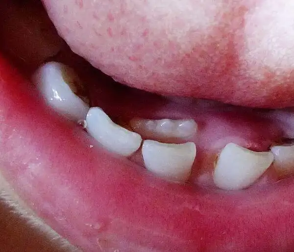 宝宝的"双层牙"是这样被"喂"出来的, 很多妈妈都还在犯