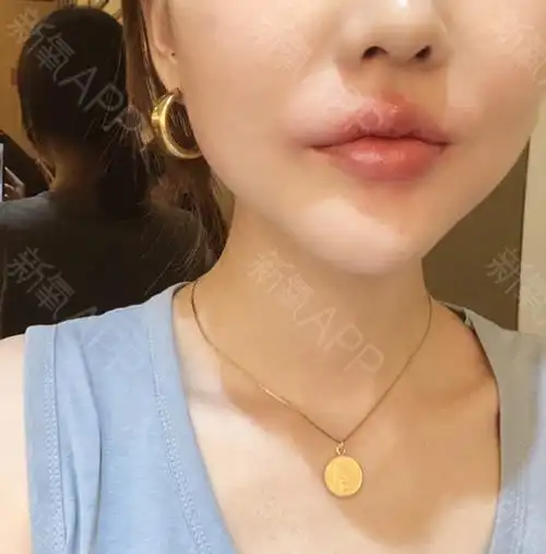 一下嘟嘟唇的过程最近好多宝宝都想打嘟嘟唇我已计_圈子-新氧美容整形