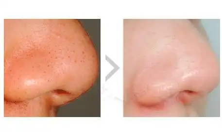 收缩毛孔前后对比
