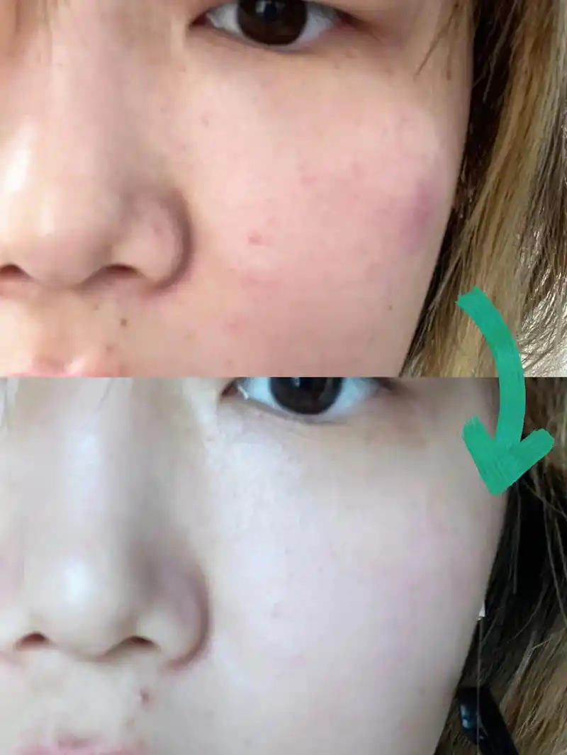 大家,前一段时间我因为用一款防晒导致过敏皮肤屏障严重受损, - 抖音