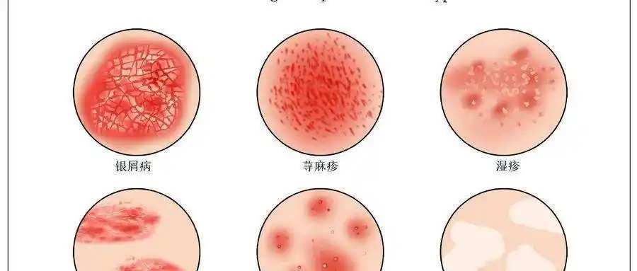湿疹与荨麻疹有什么区别?
