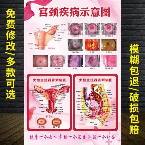 女性生殖器系统解剖宫颈疾病示意图医院妇科健康知识写真