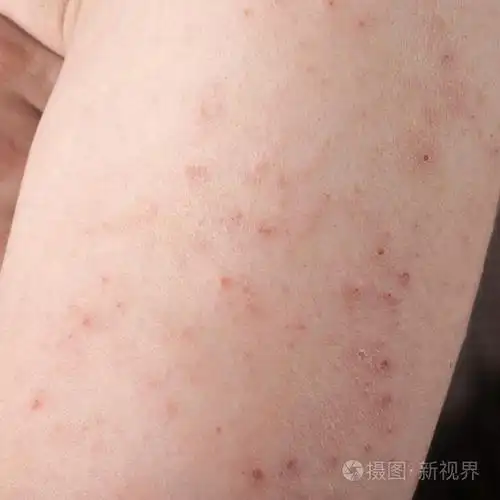 过敏性皮疹皮炎