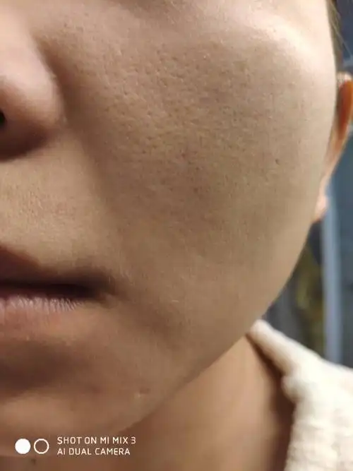 谁能看看这是什么类型的毛孔粗大 是缺水还是油光型