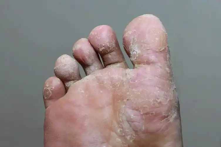 脚气也能长在脸上?_新浪财经_新浪网