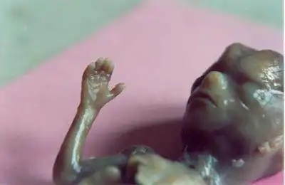 打胎后胎儿的真实照片,胎儿也是生命,打胎就是扼杀生命!