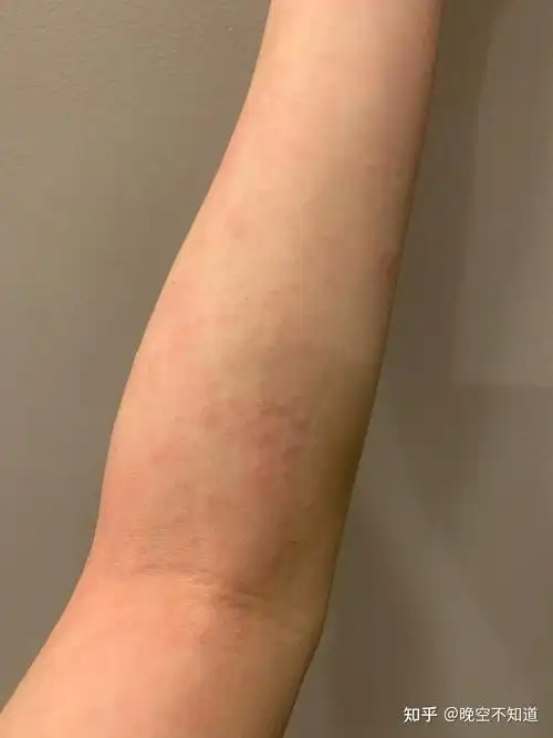 然后再涂抹上过敏修复霜,可以比较快的消除皮肤红肿瘙痒的过敏症状有