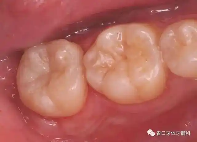 【病例分享】下颌第二磨牙根管治疗术后"印章法"树脂充填1例