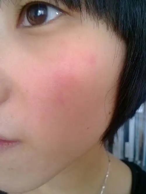 皮肤过敏,发红,发痒,脱皮 ,还有点刺痛 只在两个脸颊上.