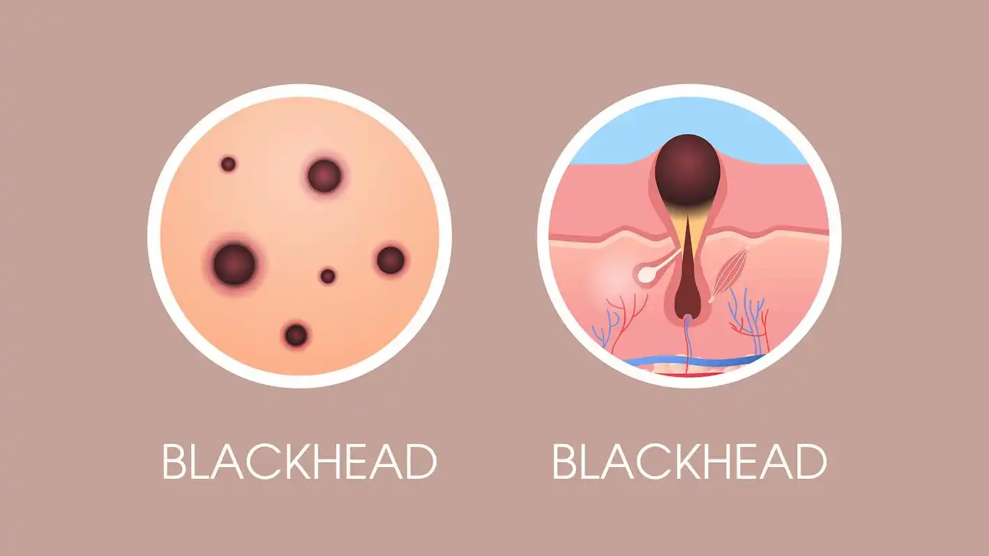 什么去黑头收缩毛孔最有效	 	"天气越来越热了…出油也变多了!