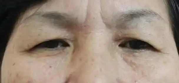 眼皮下垂的原因有很多,包括衰老,先天性问题,重度肌肉无力和眼睑肥厚.