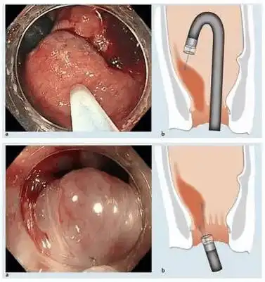 内镜下痔疮微创治疗
