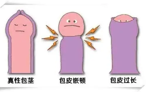 包茎过长手术前后对比图片