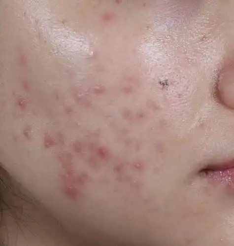 很多女生脸上的痘痘是在青春期时长出来了,慢慢的还形成了一些痘印