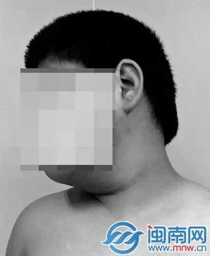 12岁的小新,因为长时间蜷缩着玩手机,脖子歪了
