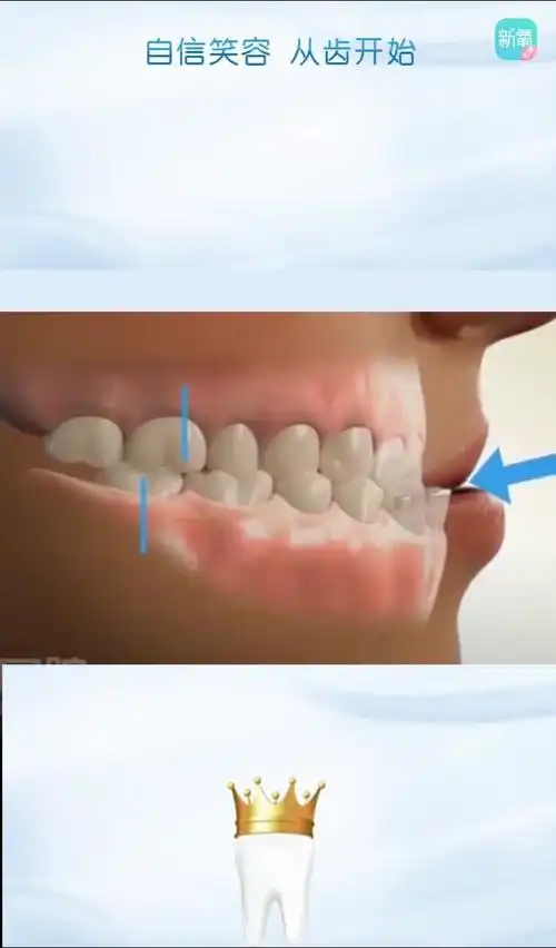 下牙包住上牙会造成怪异脸型.