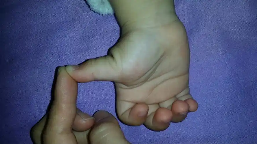 宝宝的大拇指骨头,我用手顶着变直,放手凸出,是摔伤导致,还是小儿腱鞘