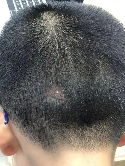 手术包括头皮肿块的切除加创面修复术,耳廓及耳后先天性疣状痣的切除