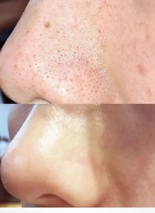 毛孔清洁膏 面部深层清洁去角质收缩毛孔死皮去黑头 清洁面霜oem