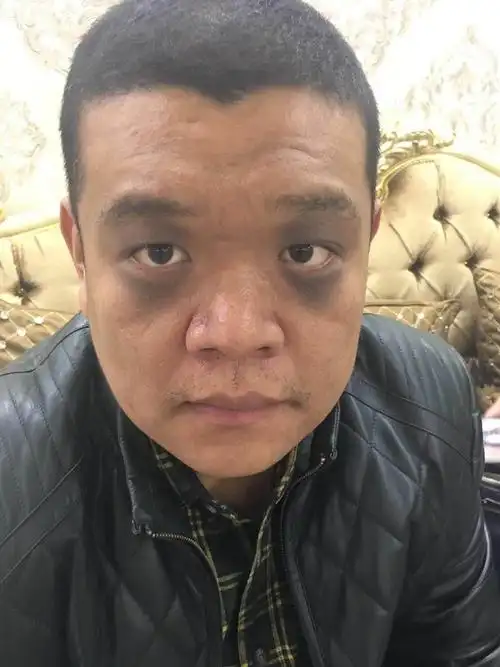 伊莲祛斑 天下无斑 真皮斑,真人案例,过程讲解.