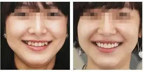 真人案例牙知道虎牙矫正前后对比有差距