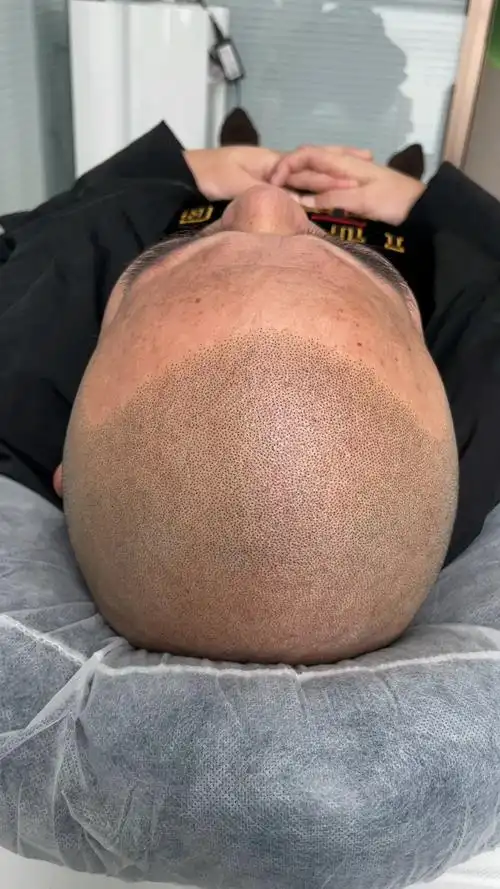 防脱发夏日脱发人士必备发型纹发寸头帅气清爽告别脱发形象