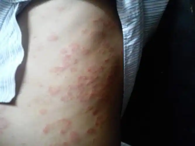 我身上长了很多红斑斑.有时发痒.有一个月了.