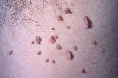 腋下丝状疣图片