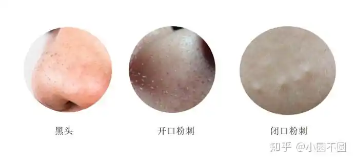 我的黑头粉刺好多密集勿进怎么办