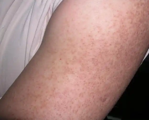 这是过敏性皮肤病么?