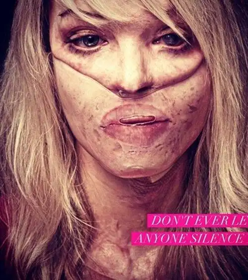 女模被泼硫酸毁容整容换脸大红大紫