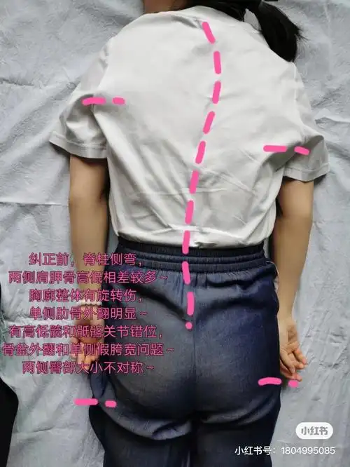 肩胛骨高低相差较多～导致出现高低肩和胸廓旋转问题～单侧肋骨外翻