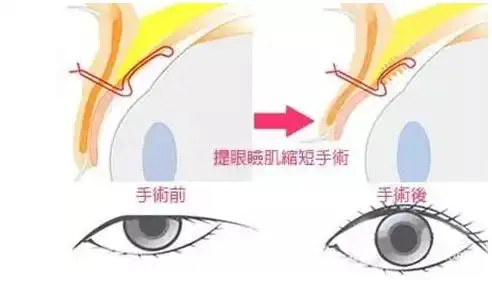 上睑下垂矫正的几种方法