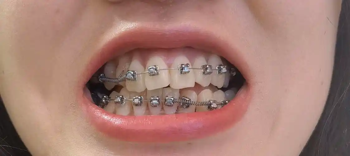 25岁中龄小虎牙女生正畸不得不说的故事 - 知乎