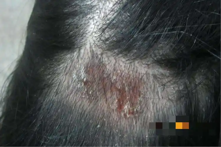 石棉状糠疹头皮屑图片