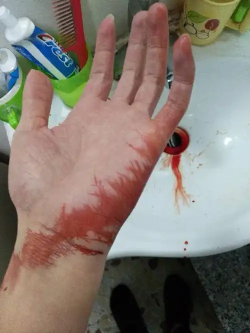 白血病血液病学嘴唇血液科 嘴唇针孔状的伤口流血不止?