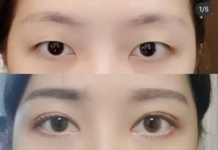 双眼皮单眼皮的区别