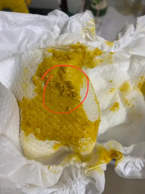 我家宝贝拉屎这样是奶瓣吗?