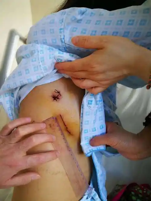 美少女胸腔镜辅助下的微创房间隔缺损修补术 - 好大夫在线