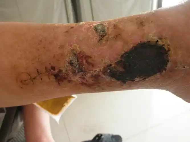 胫腓骨开放性骨折术后皮肤坏死怎么办?