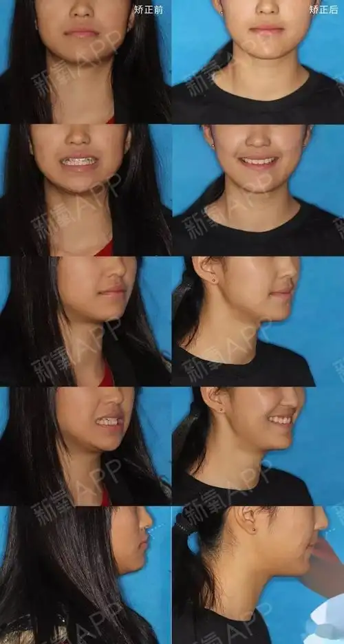 嘴突拥挤虎牙,23个月精致少女感达成!▌矫正前后面_圈子-新氧美容整形