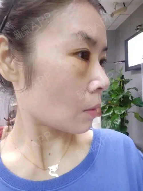 做了眼袋泪沟术后第三天,只是第一天的时候眼睛肿胀的_圈子-新氧美容