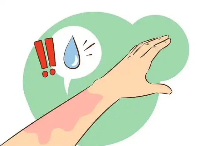 治疗接触性皮肤炎(受刺激或过敏皮肤)