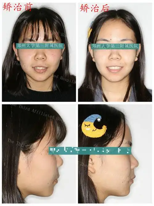 小虎牙该不该一拔了之听听口腔科专家咋说