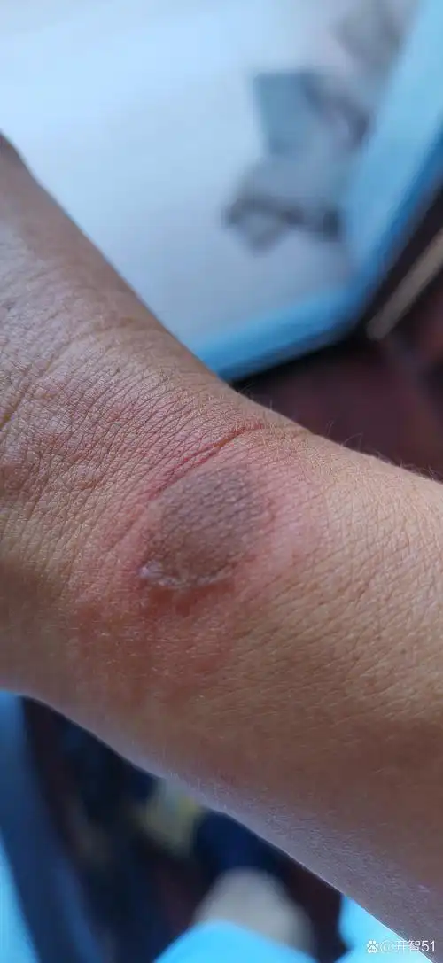 大神们,请教一下,什么虫毒会让皮肤坏死?