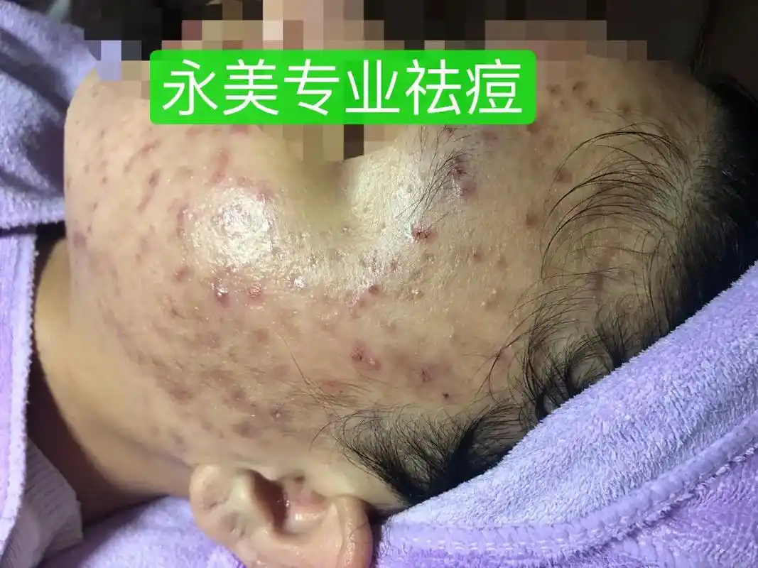 永美二十周年专业祛痘#/#螨虫克星 #素颜女神 #顽固皮肤病 - 抖音