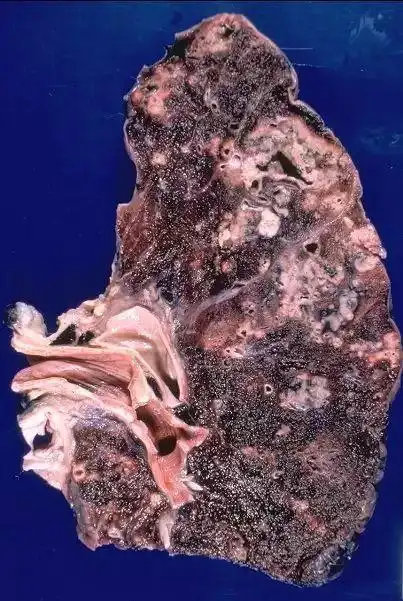 空洞型肺结核【多图】_39医疗图集-39健康网